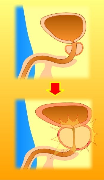 前立腺肥大のイメージ図