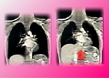 肺のCT画像