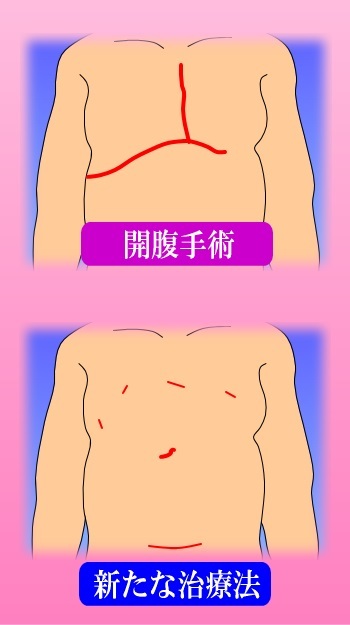 腹腔鏡下肝切除手術のイメージ図