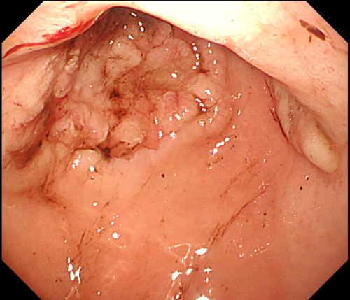 胃のリンパ腫1