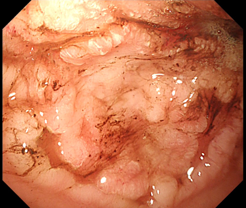 胃のリンパ腫2
